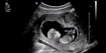 Arkansas Has Passed 63 Laws Saving Babies From Abortion