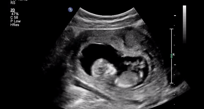 Arkansas Has Passed 63 Laws Saving Babies From Abortion