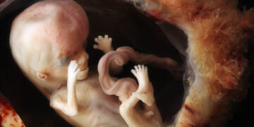 Louisiana Fights to Protect Its Pro-Life Laws Saving Babies From Abortions