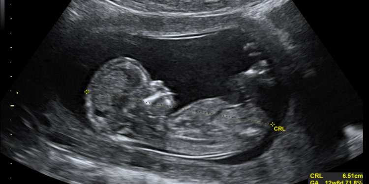 Abortion is Wrong Because Every Human Life Matters