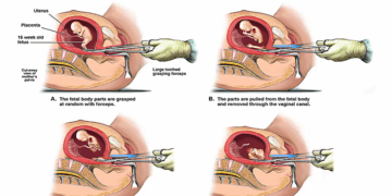 Abortionists Rips Babies Apart, Tearing off Their Limbs. That’s Not Health Care