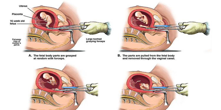 Abortionists Rips Babies Apart, Tearing off Their Limbs. That’s Not Health Care