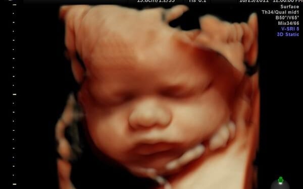 Pro-Life Group Tells Congress: No Abortion Funding in Obamacare