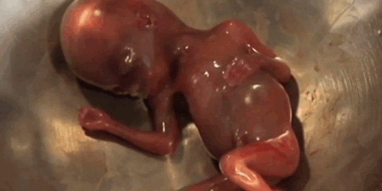 Woman Traumatized by Seeing Her Aborted Baby at 17 Weeks