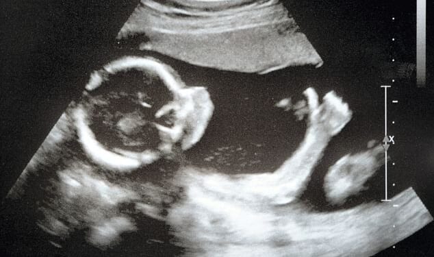 Protect the Hyde Amendment: No Abortion Funding in Obamacare