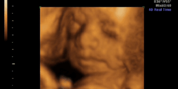 Texas and Florida Sue FDA Over Dangerous Abortion Pills