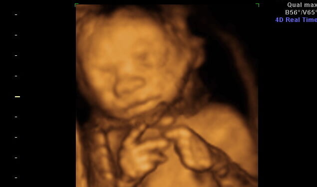 UK Killed Almost 300,000 Babies in Abortions in 2023