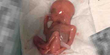 Baby Left to Die Sucking His Thumb After Botched Abortion