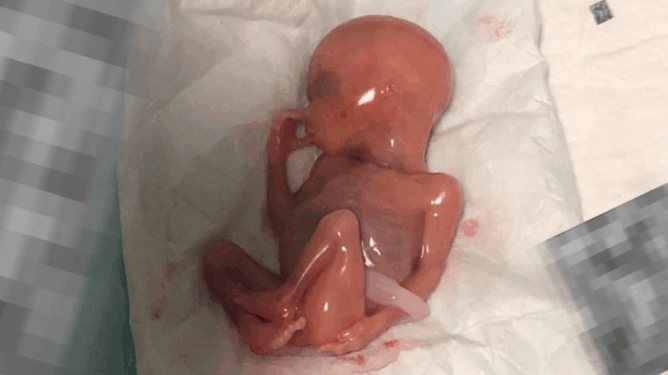 Baby Left to Die Sucking His Thumb After Botched Abortion