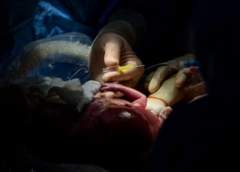 Doctors are Performing Surgeries on Babies the Womb to Treat Spina Bifida