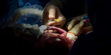 Doctors are Performing Surgeries on Babies the Womb to Treat Spina Bifida