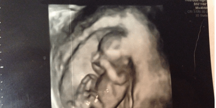 Massachusetts Legislature halts Bill to Expand Abortions