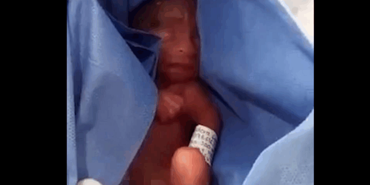Five Month Old Baby Survived Abortion, Then Had Her Organs Harvested