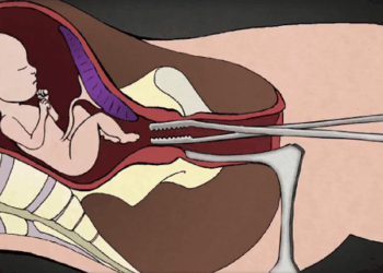 New Congressional Bill Will Ban Dismemberment Abortions Tearing Babies Limb From Limb