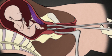 New Congressional Bill Will Ban Dismemberment Abortions Tearing Babies Limb From Limb