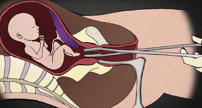 New Congressional Bill Will Ban Dismemberment Abortions Tearing Babies Limb From Limb