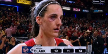 Image for article: Caitlin Clark Records Triple Double With 10 Fractures, 11 Concussions, 13 Teeth Knocked Out