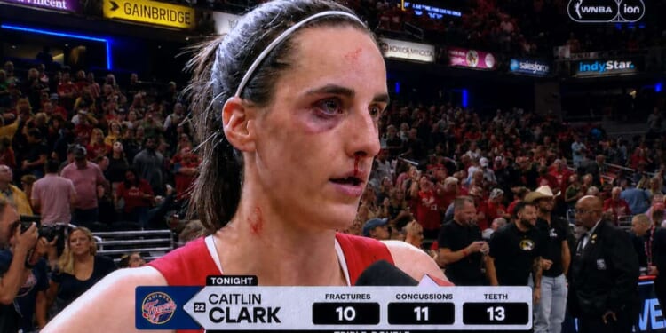 Image for article: Caitlin Clark Records Triple Double With 10 Fractures, 11 Concussions, 13 Teeth Knocked Out