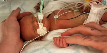 Premature Baby Boy Born Without a Heartbeat Miraculously Survives