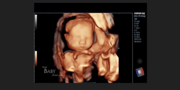 Abortions Could Surge in States With Abortions Up to Birth