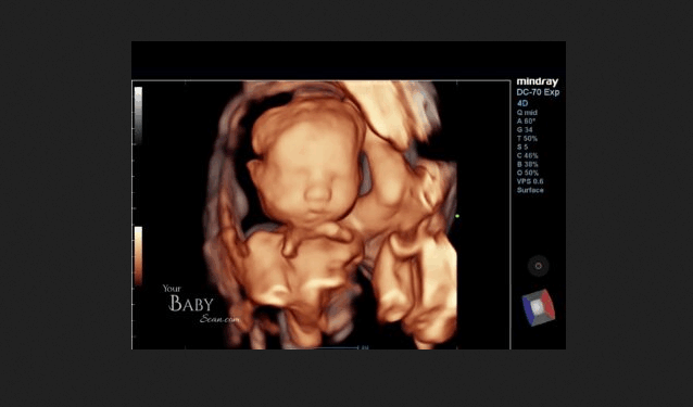 Abortions Could Surge in States With Abortions Up to Birth